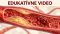 Edukativne video o cievnom pláte a krvnej zrazenine